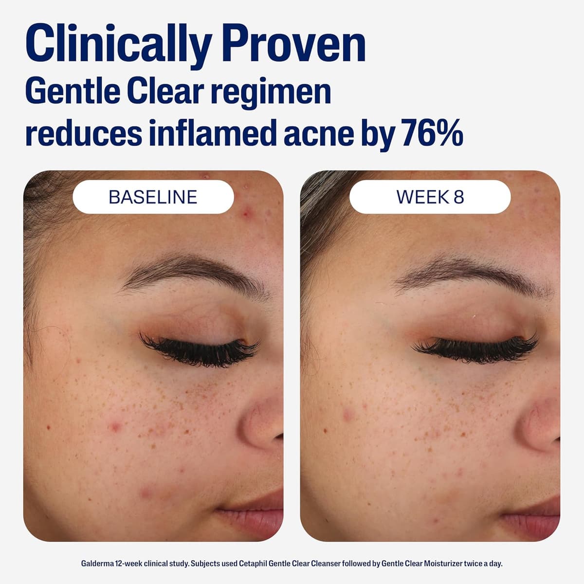 Cetaphil Mattifying Acne Moisturizer