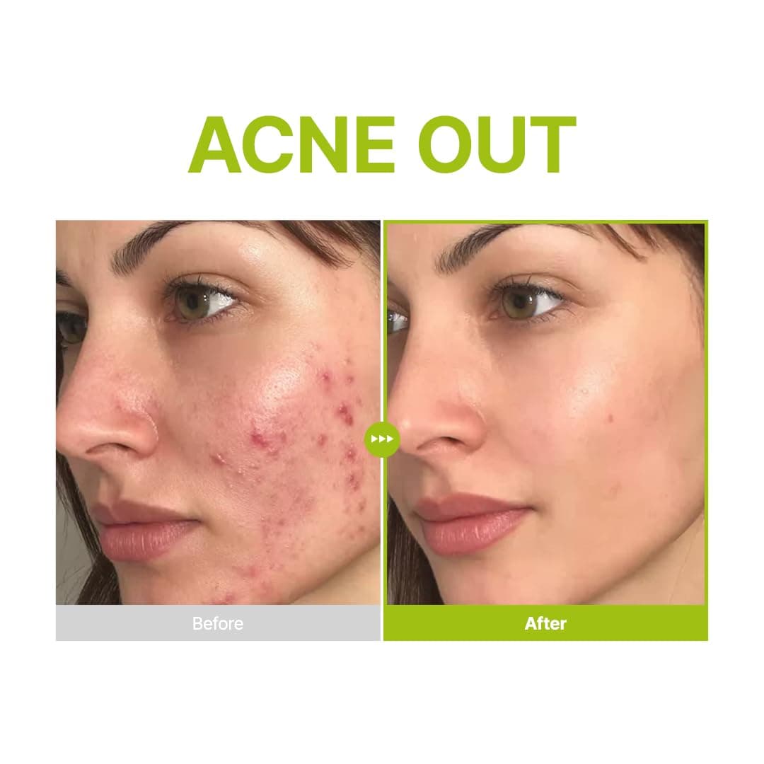 Purito Azelaic Acid 10 Kojic Tea Tree Serum